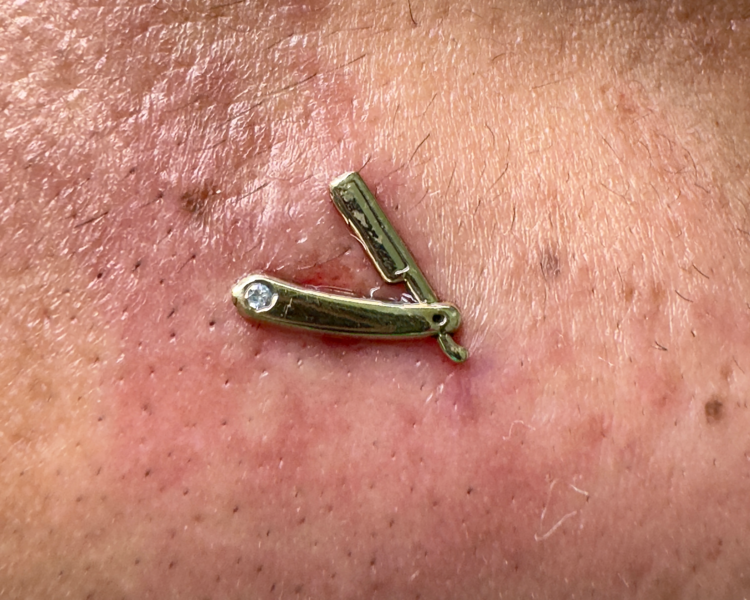 MICRODERMAL O SURFACE