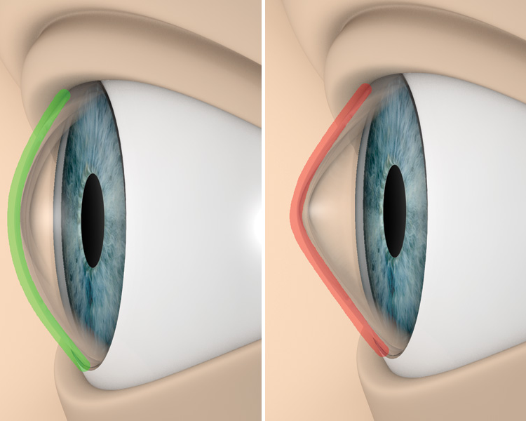 Adaptación queratocono