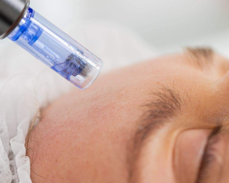 Microneedling
