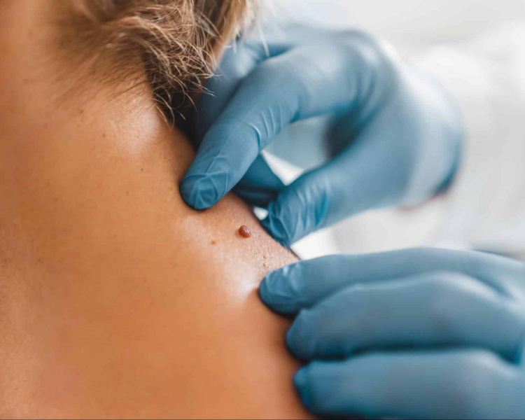 Eliminacion de verrugas