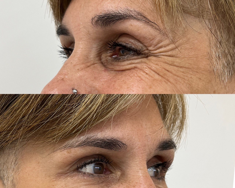 BOTOX 3 ZONAS (1 SESION)