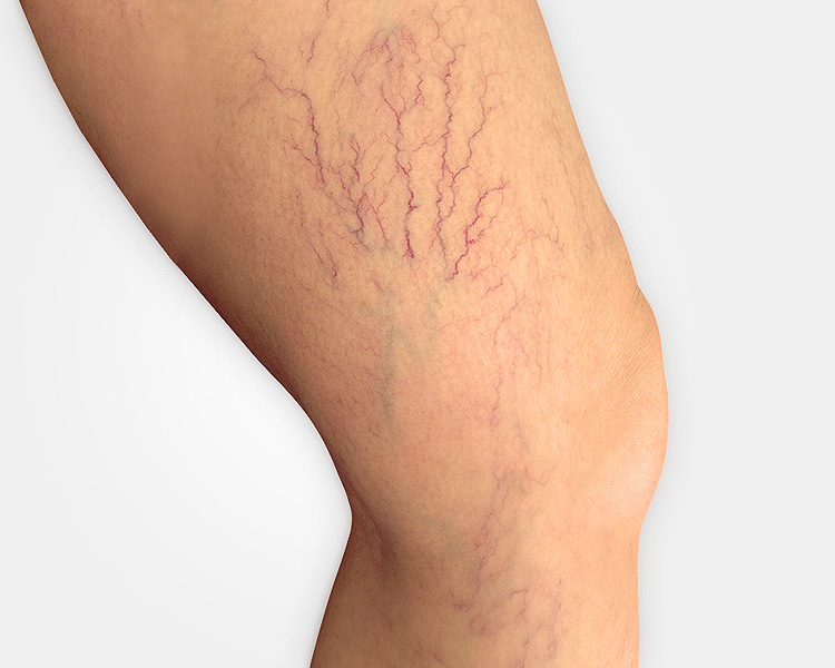 *Consulta Gratis*  Tto. de *Arañitas*