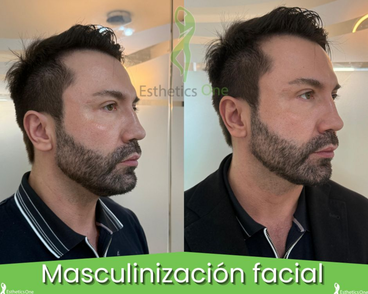 *Consulta Gratis* Tto. de *Diseño de Mentón*