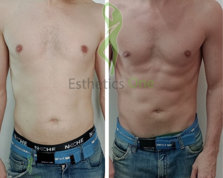 *Consulta Gratis* Tto. de *Marcado de abdomen*