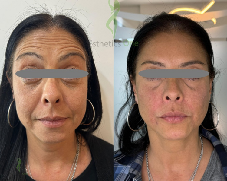 *Consulta* Tto. de  *Surcos Nasogeniano*