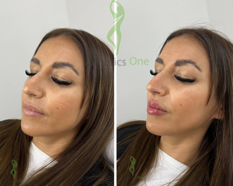 DISEÑO DE LABIOS CON ACIDO HIALURONICO 