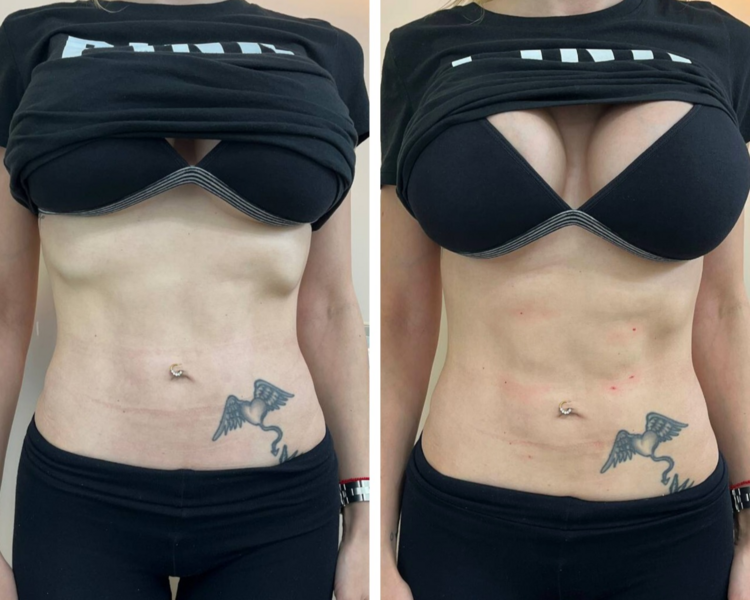 Endopeel Marcado de Abdomen X 1 Sesión 