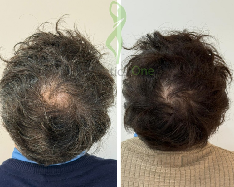 *Consulta* Tto. de *Mesoterapia*