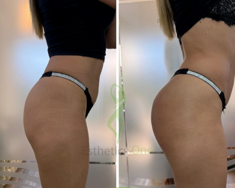 GLUTEOS 3 PEPTONAS + ENDOPEEL