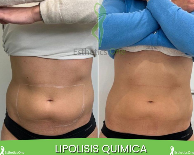 LIPOLISIS QUIMICA EN ABDOMEN