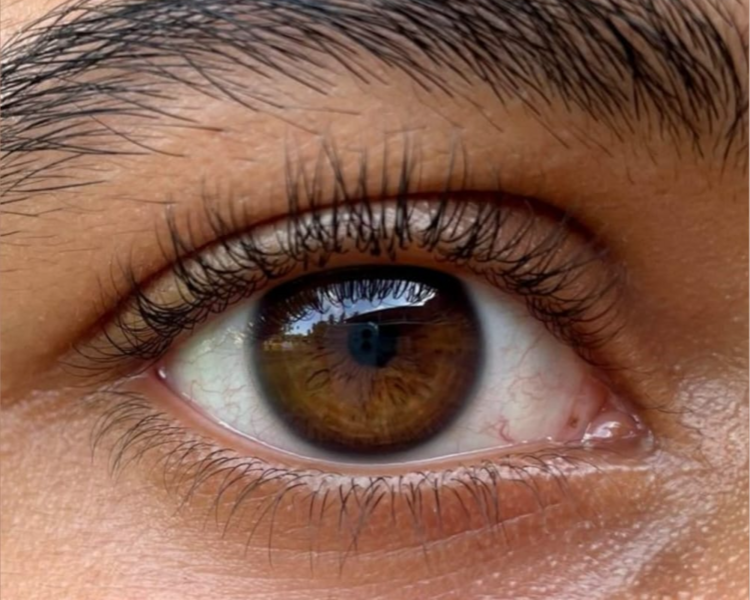 TRATAMIENTO PARA OJERAS