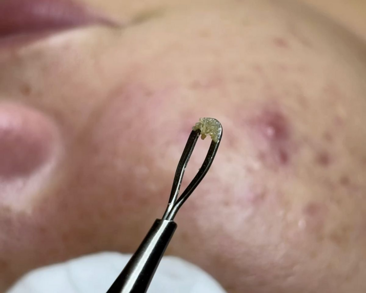 Limpieza facial profunda + extracciones de puntos negros