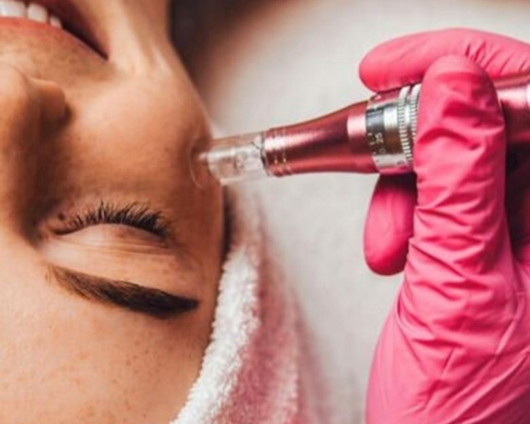 Microneedling Corporal