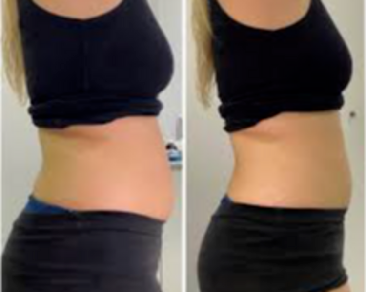 Liposonix corporal 4 zonas 