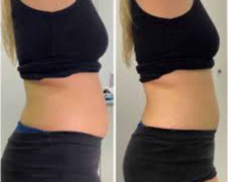 Liposonix corporal 2 zonas