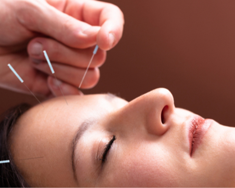 5 Acupunturas
