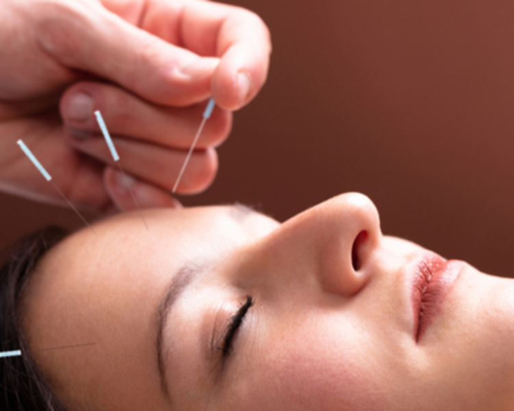 10 Acupuntura