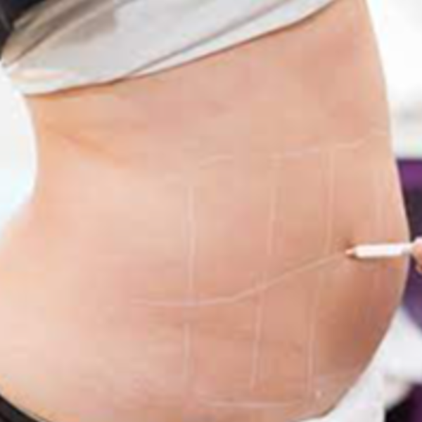 TRATAMIENTO DE REDUCCIÓN 450 