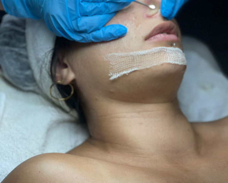 Limpieza facial profunda 