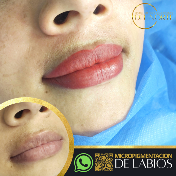 Retoque de Labios
