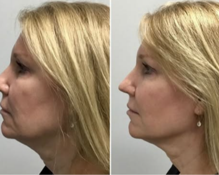 Toxina botulínica: NEFERTITI LIFT