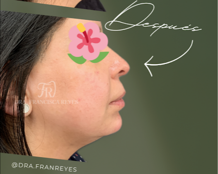 Ácido hialurónico: aumento de mentón (1 mL)