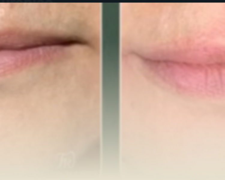 Ácido hialurónico: aumento de labios