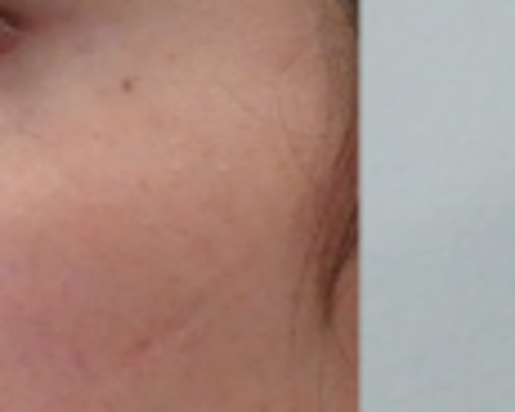 Ácido hialurónico: Rinomodelación (1mL)