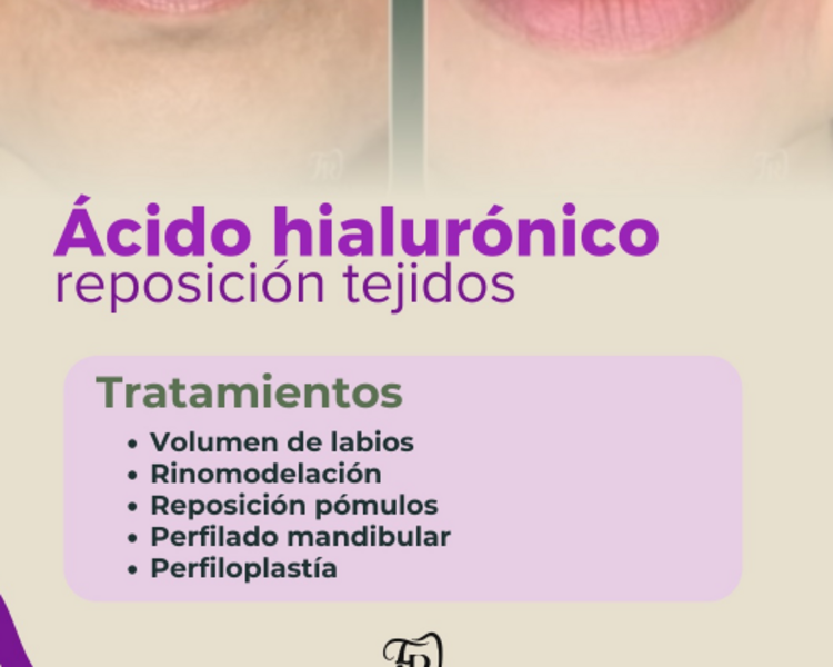 Ácido hialurónico: Relleno pómulos (1 mL)