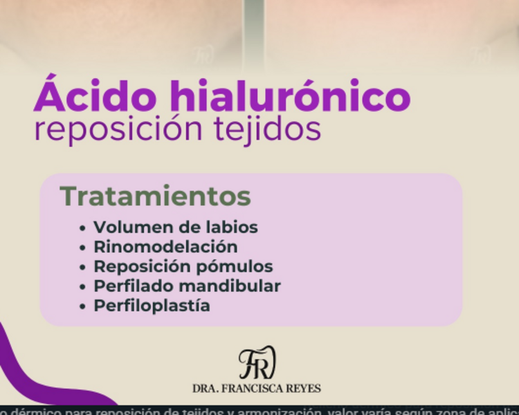 Ácido hialurónico: Perfiloplastía (3 mL)