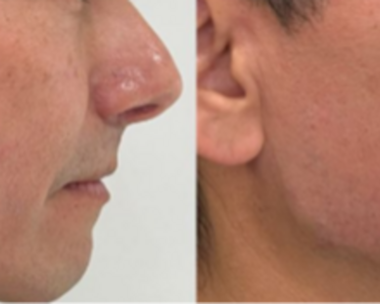 Ácido hialurónico: Perfilado mandibular (1mL)