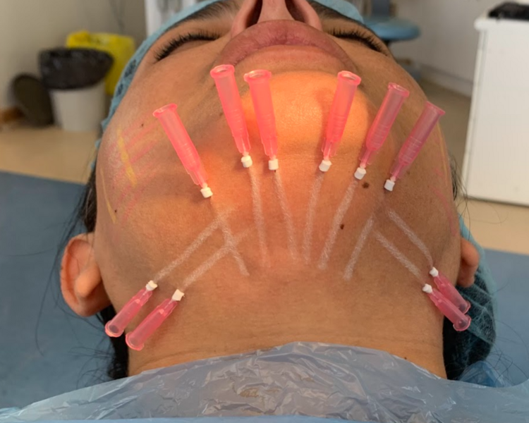 Hilos revitalizantes (20 hilos)