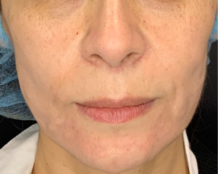 Hilos tensores (8 hilos)