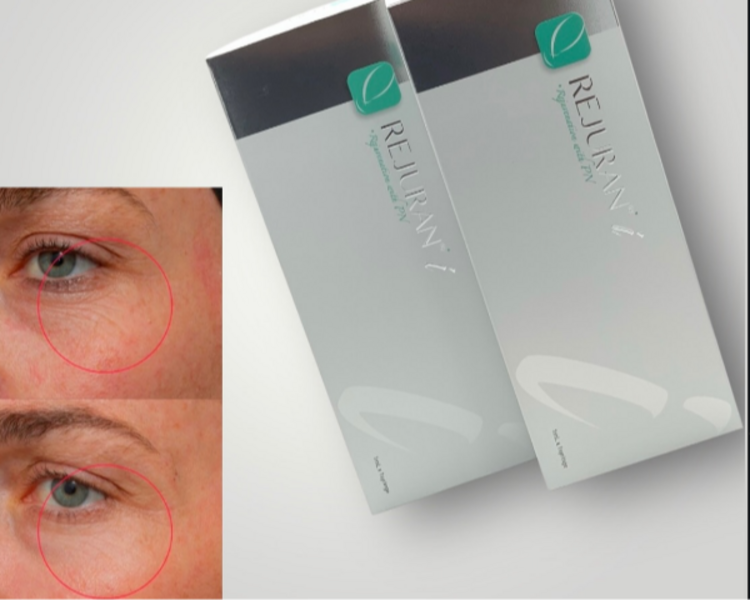 Ojeras: Polinucleotidos (Rejuran) 1 sesión