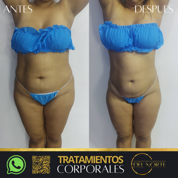 Tratamiento de REDUCCIÓN*10