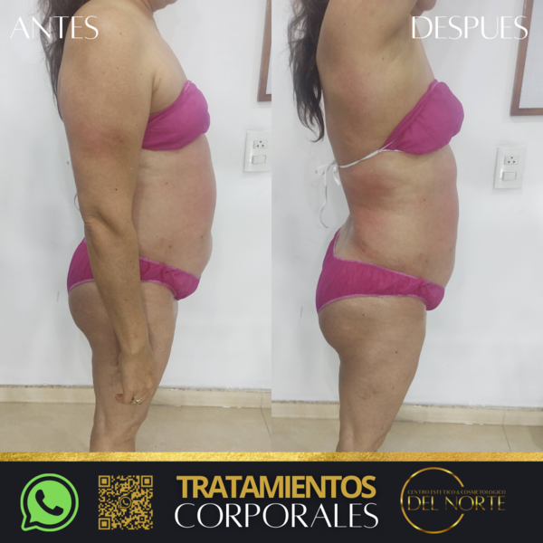 Tratamiento de REDUCCIÓN*5