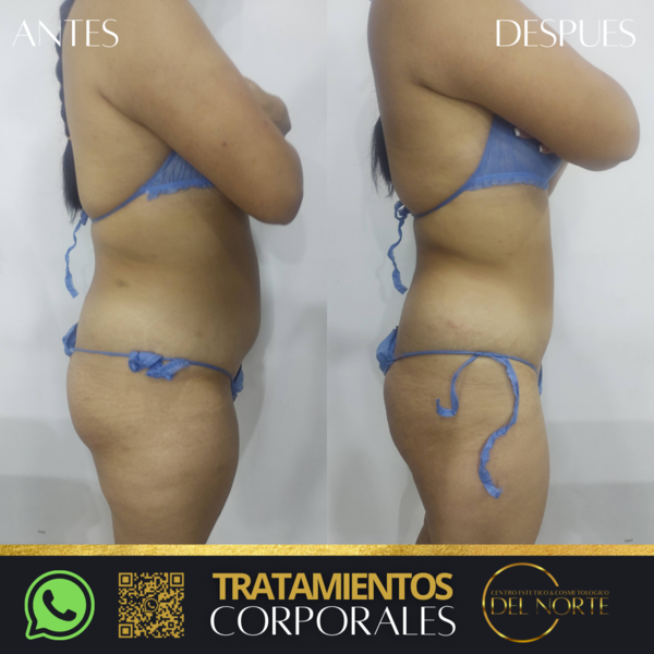 Tratamiento de TONIFICACIÓN-MOLDEO*10