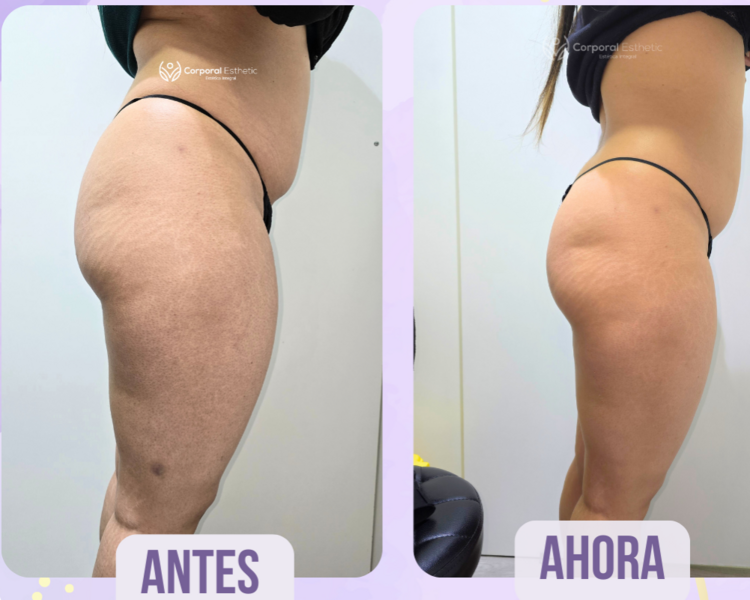 PACK 3 SESIONE PRP GLUTEO