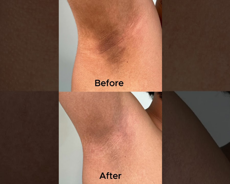 DESPIGMENTACION DE AXILAS PACK X3 SESIONES