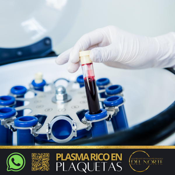 Plasma Rico en Plaquetas (FACIAL)
