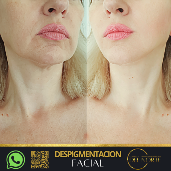 Tratamiento de DESPIGMENTACION FACIAL