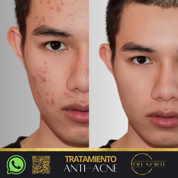 Tratamiento para el ACNE