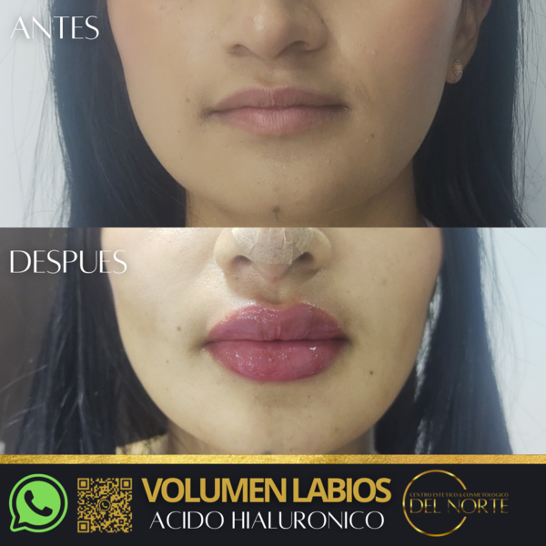 Ácido Hialuronico VOLUMEN LABIOS 
