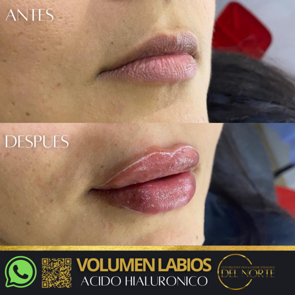 Ácido Hialuronico PERFILAMIENTO LABIOS 