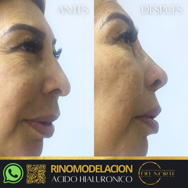 Ácido Hialuronico RINOMODELACION