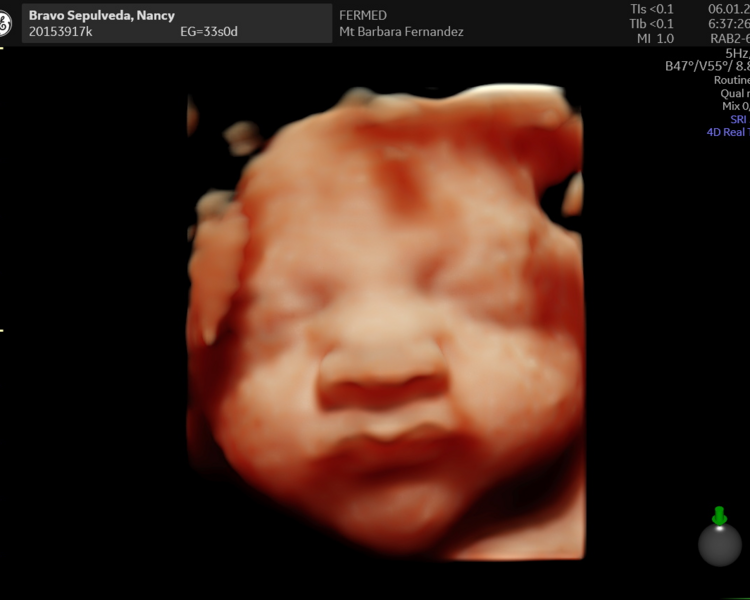 Ecografía 5D