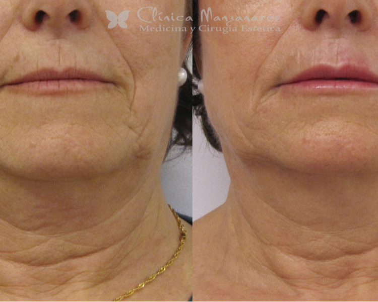 Micrineedling 1 Sesion