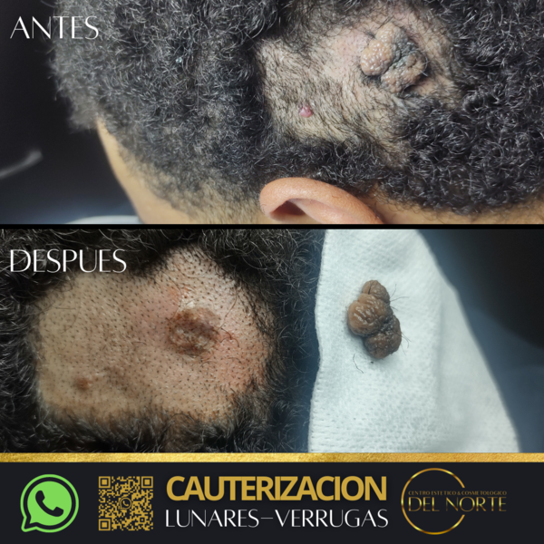 CAUTERIZACION de lunares y verrugas 
