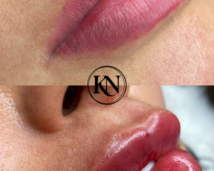 Labios ácido hialuronico 