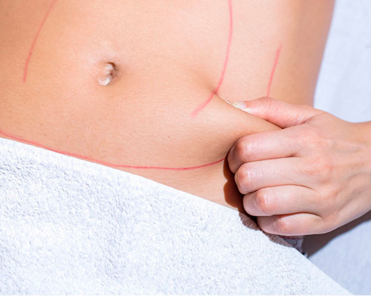 Tratamiento Antiflacidez